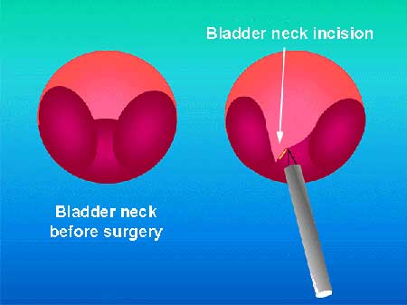 Bladder Neck Incision (B.N.I.) and Urethrotomy