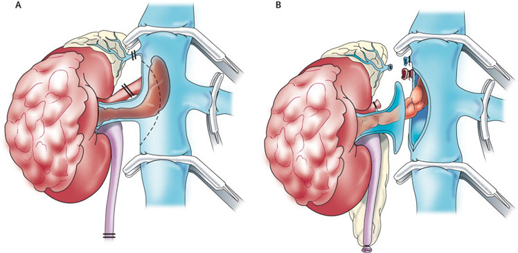 kidney cancer treatment in ghaziabad