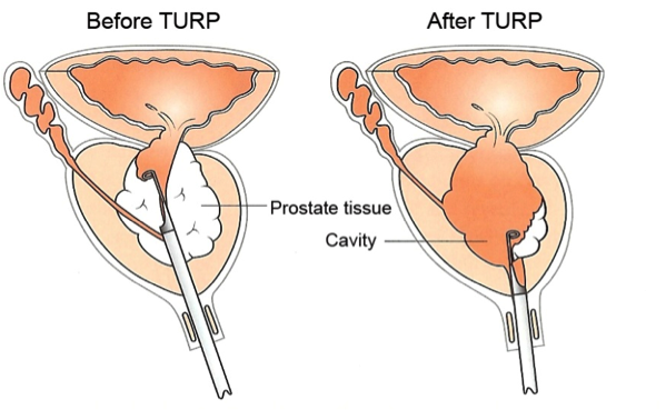 prostate laser surgery in ghaziabad